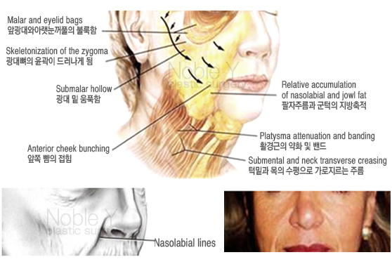 팔자주름