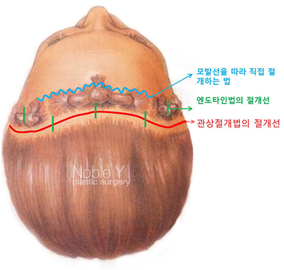 이마눈썹거상술