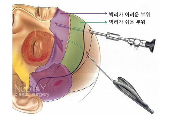 이마눈썹거상술