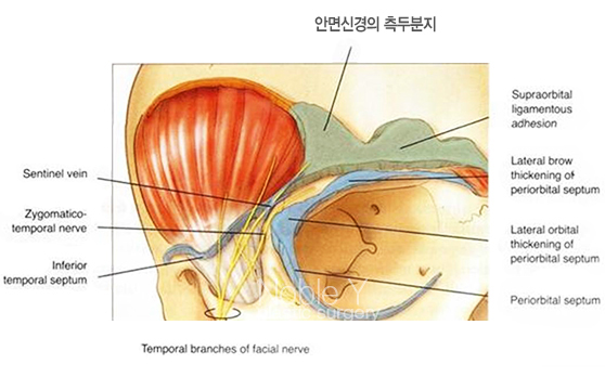 이마눈썹거상술