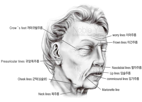 볼처짐(안면거상술)