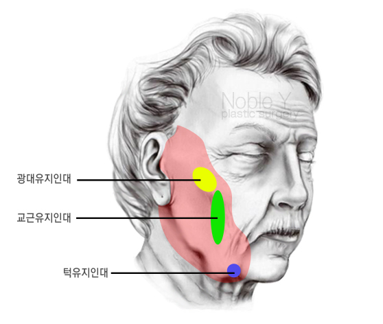 볼처짐(안면거상술)