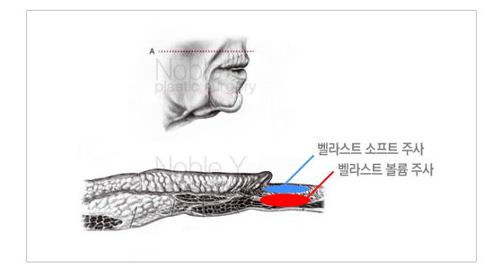 팔자필러